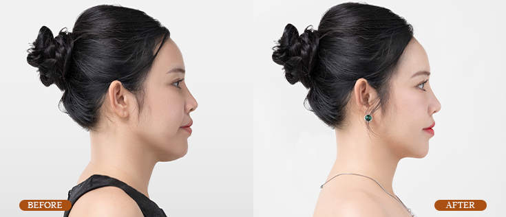 before-after