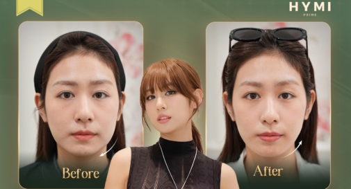 nang-co-da-tang-prolift-04