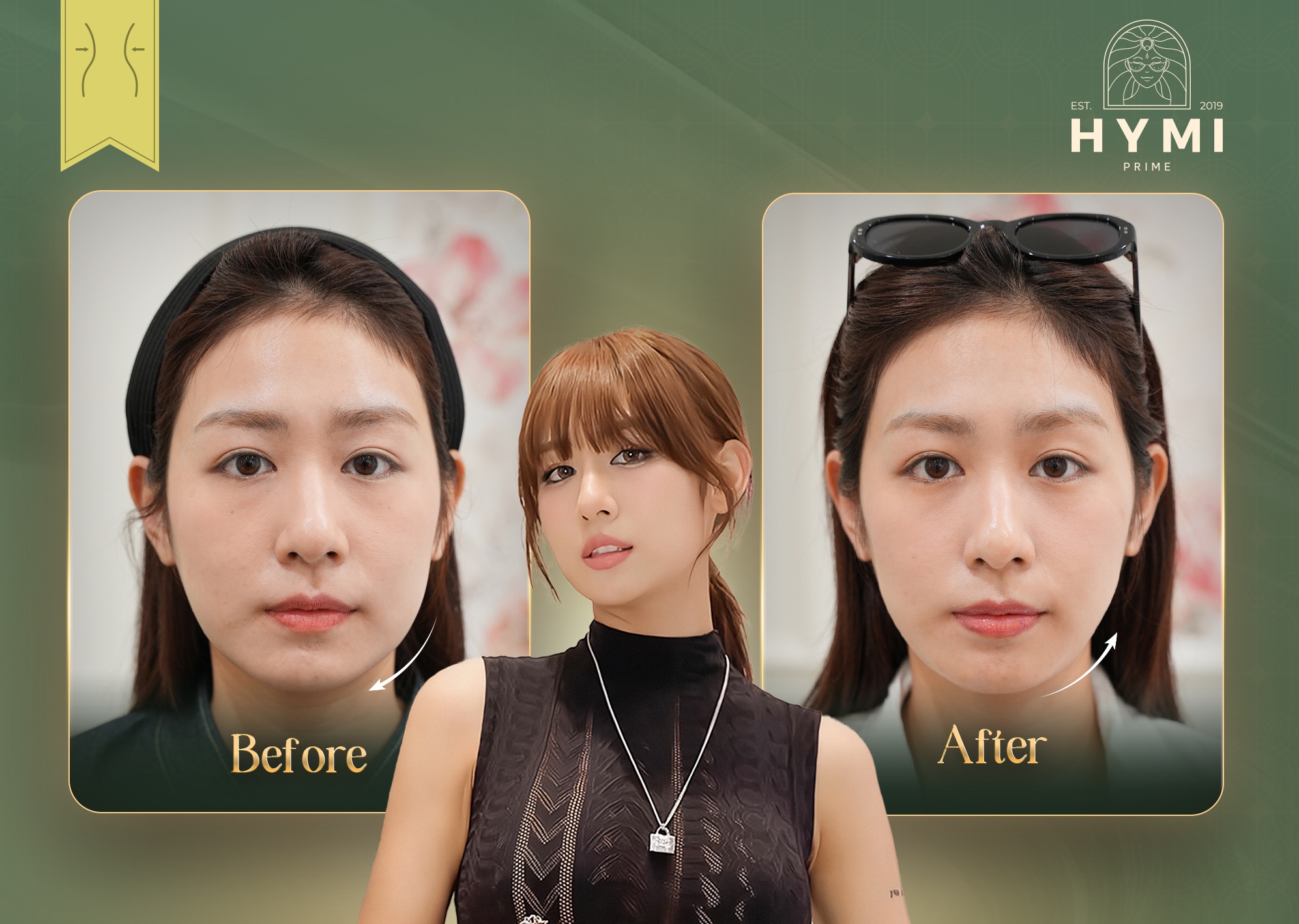 nang-co-da-tang-prolift-04