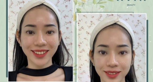 filler-ranh-cuoi