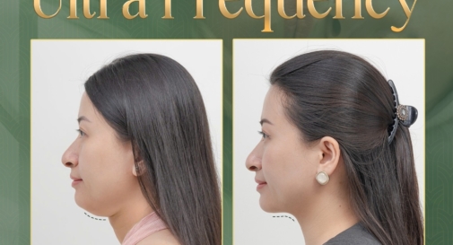 giam-mo-ultra-frequency