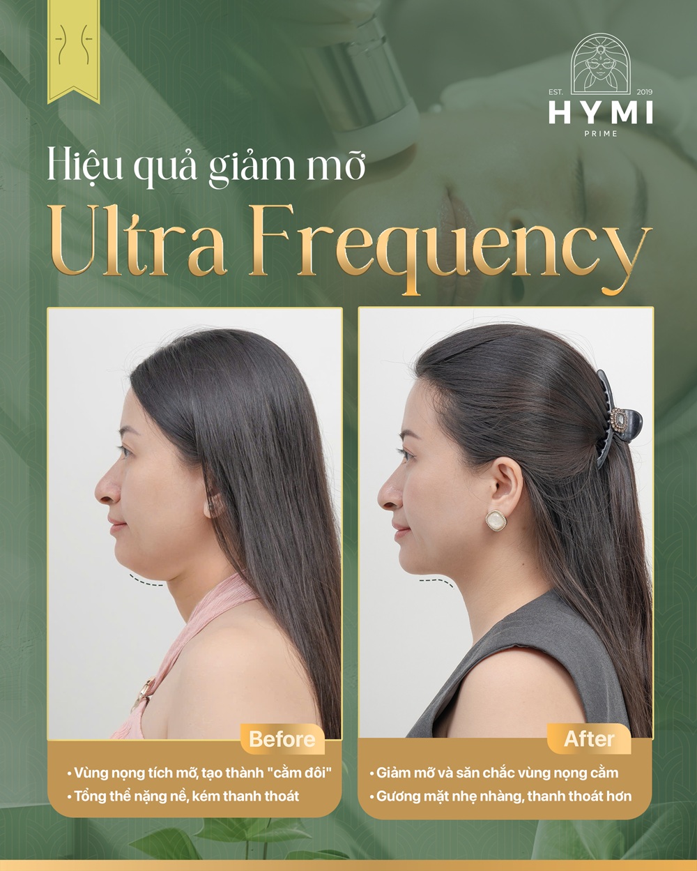 giam-mo-ultra-frequency