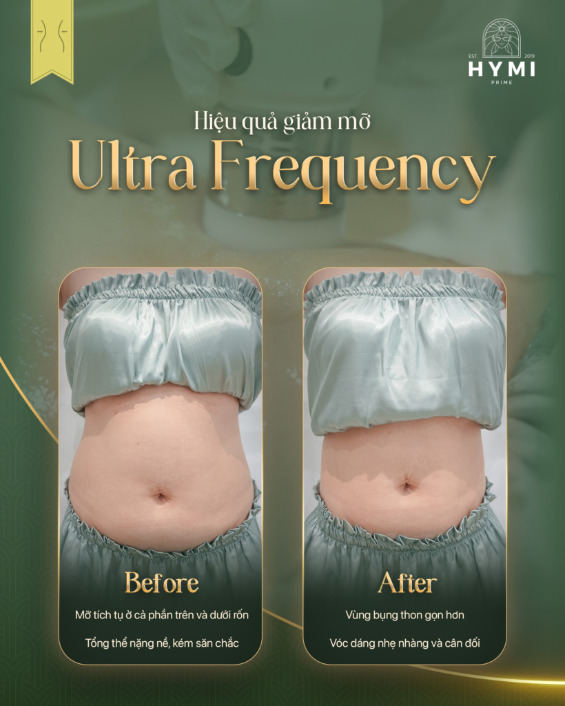 giam-mo-ultra-frequency-01