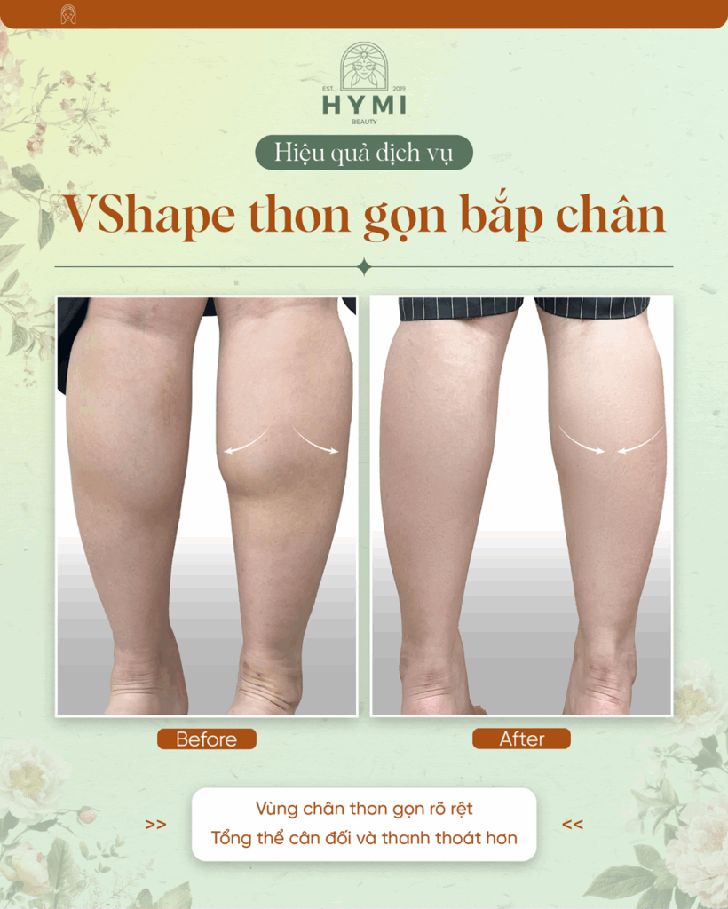 vshape-thon-gon-bap-chan