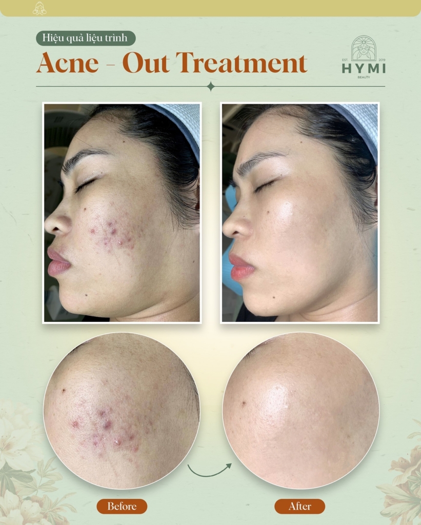 ACNE-OUT-TREATMENT-10
