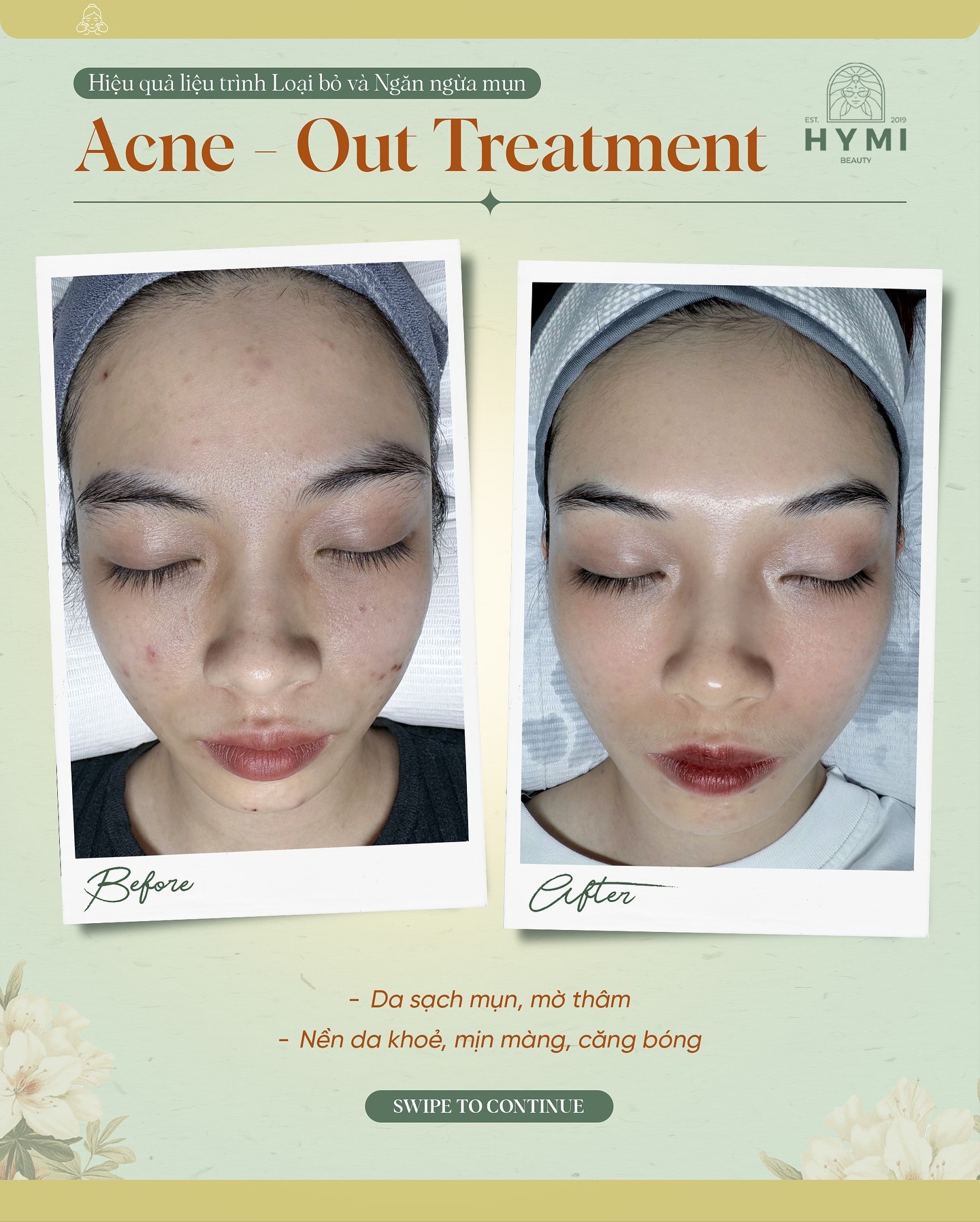 ACNE-OUT-TREATMENT-08