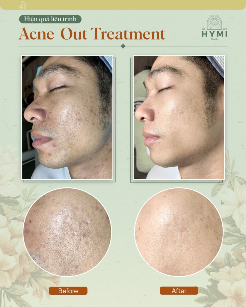ACNE-OUT-TREATMENT-07