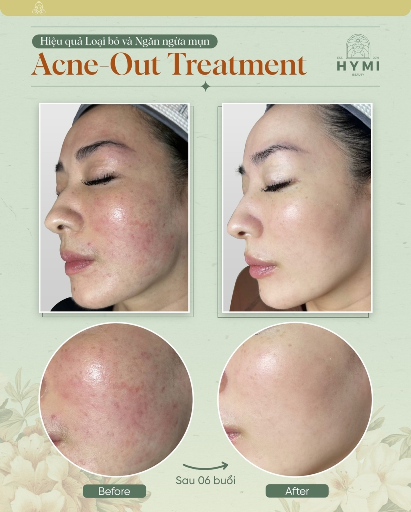 ACNE-OUT-TREATMENT-09