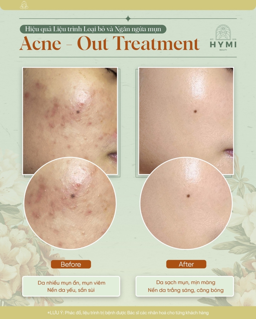 ACNE-OUT-TREATMENT-11
